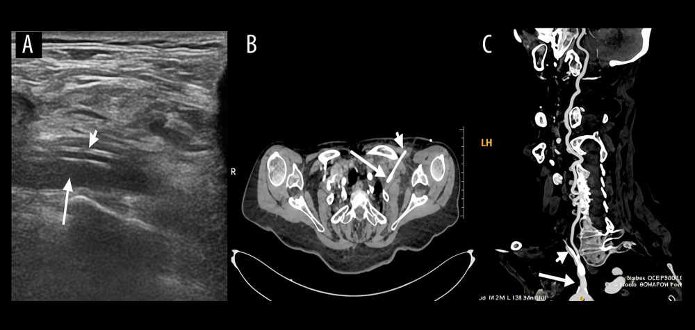 (A, B) Duplex ultrasonography of the cervical vessels and contrast-enhanced CT confirm the malposition of the central venous catheter (short arrow) within the left subclavian artery (long arrow). (C) Maximum intensity projection (MIP) reconstruction demonstrates the central venous catheter located in the left subclavian artery (long arrow), with the catheter tip (short arrow) positioned near the arterial origin.