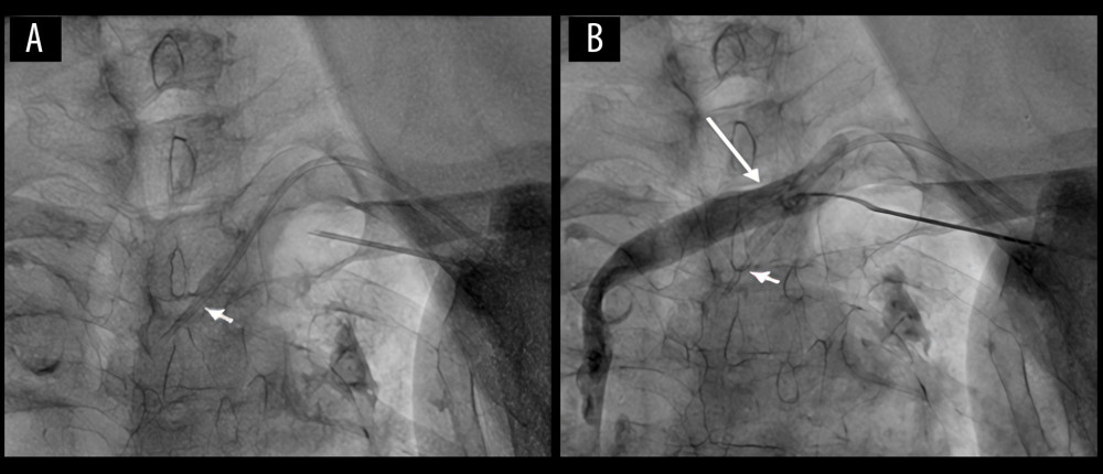 (A, B) Real-time fluoroscopy shows the malpositioned central venous catheter (short arrow). Contrast venography of the left subclavian vein (long arrow) demonstrates no evidence of contrast extravasation.