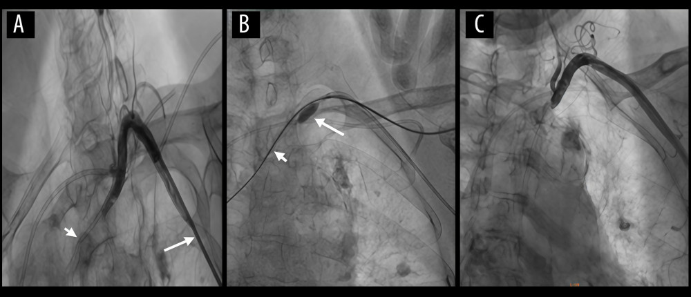 (A) Angiography performed with a JR4.0 catheter (long arrow) demonstrates the central venous catheter (short arrow) malpositioned within the left subclavian artery. (B) A 5.0×8 mm NC TREK balloon (long arrow) was continuously inflated to achieve temporary flow occlusion. A 6F ExoSeal vascular closure device (Cordis) (short arrow) was then deployed through the malpositioned central venous catheter and gradually withdrawn to close the injured vessel. (C) Postoperative follow-up angiography shows no evidence of arterial aneurysm or dissection.