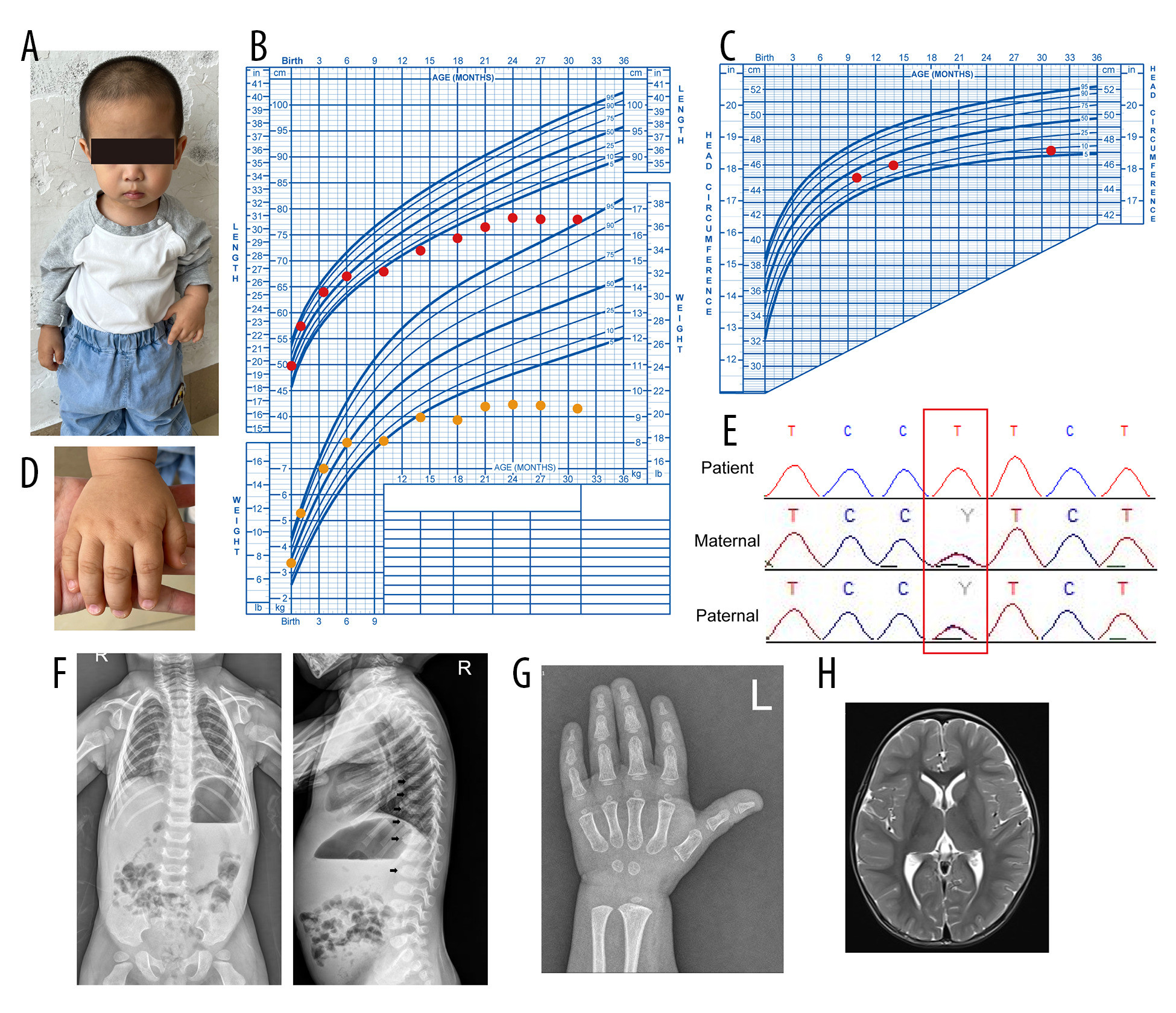 Detection and location of TOMM7 mutations in the patient(A) Anterior view of the patient at 31 months of age, showing severe short stature and relative macrocephaly. (B) Length and weight of the patient from birth to 31 months before human growth hormone administration. Growth velocity was normal before 6 months and substantially slowed thereafter. Length and weight continued to be monitored. Growth arrested between 24 and 31 months of age. Red dots represent length; orange dots represent weight. (C) Head circumference measurements at 10, 14, and 31 months. These values were between the 25th and 5th percentiles compared with normal reference standards. (D) View of the patient’s hand, showing relatively broad hands with a distinctive shape and small, dystrophic nails. (E) Sanger sequencing of the TOMM7 variant revealed that the patient carried a homozygous mutation inherited from his parents (c.86C>T, p.Pro29Leu) (red box). (F) Radiograph of the spine showing anterior beaking of several vertebrae (black arrows). (G) Left-hand radiograph at 31 months of age, indicating a skeletal age of approximately 2 years. (H) Representative cerebral magnetic resonance imaging images of the patient.