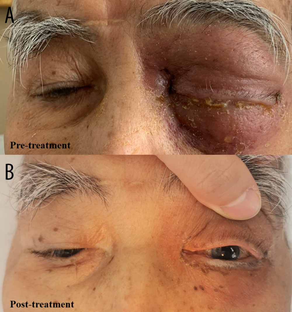 (A) The patient’s ocular condition at admission. The right eye appeared essentially normal; the left eye demonstrated severe eyelid swelling, increased skin tension, and rigidity of the skin and subcutaneous tissues, preventing voluntary eye opening. Ocular motility was completely restricted and fixed. (B) After chemoradiotherapy, there was a substantial reduction in eyelid edema within the left eye, as well as pronounced improvement in skin tension. The patient was able to open the eye with assistance.