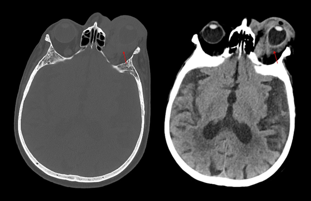 Orbital computed tomography scans revealed deformation of the left globe, indicating structural pathology. Images showed diffuse involvement of both intra- and extraconal spaces, suggesting extensive lesions possibly due to inflammatory or neoplastic processes. The tent-shaped configuration of the globe suggested increased tension, likely resulting from an internal mass or edema. Evidence of optic nerve traction was also present, possibly secondary to elevated intraocular pressure or direct compression. Soft tissue thickening along the posterior wall of the left nasopharynx was noted, which may represent inflammation or a mass.