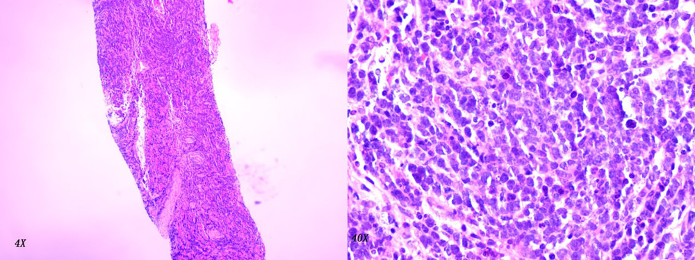 At low-power magnification (4×), a dense, infiltrative lesion with a diffuse growth pattern was observed. The lesion lacked distinct margins and invaded adjacent tissues, consistent with a high-grade neoplasm. No organized structures such as follicles or glands were present. At high-power magnification (40×), clusters of large, atypical lymphoid cells were visible, characterized by irregular nuclear contours, prominent nucleoli, and dispersed chromatin. Numerous mitotic figures indicated rapid cellular proliferation. The absence of differentiation toward other hematologic lineages further supported a diagnosis of lymphoid malignancy.