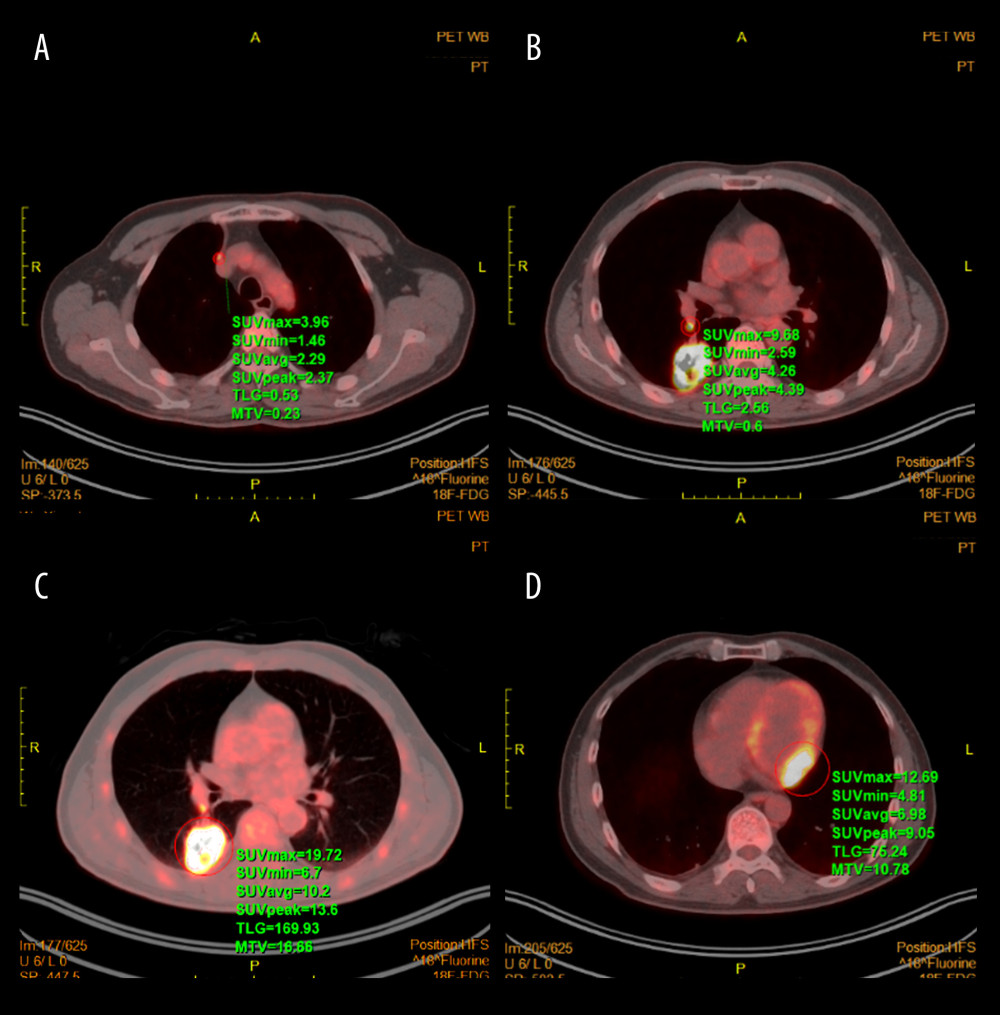 PET-CT images. (A) Mediastinal lymph nodes; (B) Hilar lymph nodes; (C) Adenocarcinoma of the right lower lung lobe; (D) Myocardial metastases in the left ventricle.
