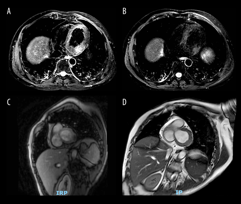 Cardiac MRI images. (A, C) Myocardial metastases before treatment; (B, D) Myocardial metastases after treatment.