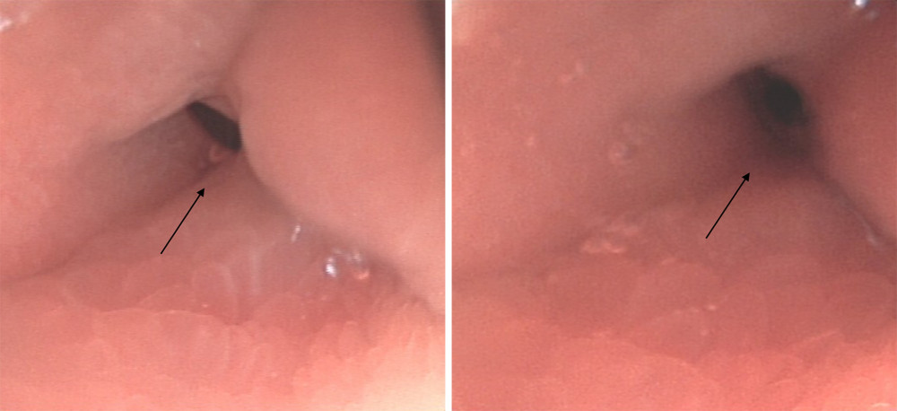 Electronic gastroscopy reveals deformation of the duodenal bulb, with stenosis observed at the junction of the duodenal bulb and its descending portion. The black arrow indicates stenosis at the junction of the duodenal bulb and the descending part of the duodenum.