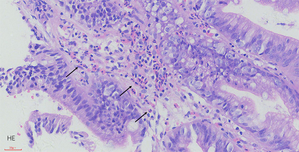 The pathological results indicate extensive infiltration of eosinophils in the duodenal bulb. The black arrow indicates eosinophils.