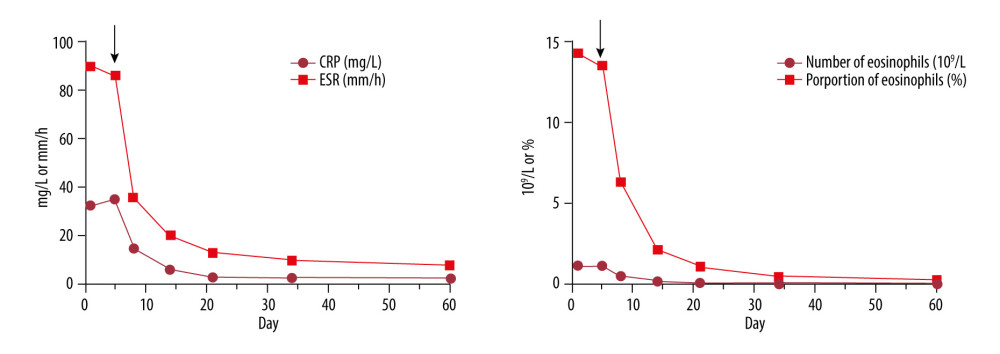 Dynamic changes in erythrocyte sedimentation rate (ESR), C-reactive protein (CRP), and eosinophils during the treatment. The black arrows indicate the day of glucocorticoid and cyclophosphamide therapy.