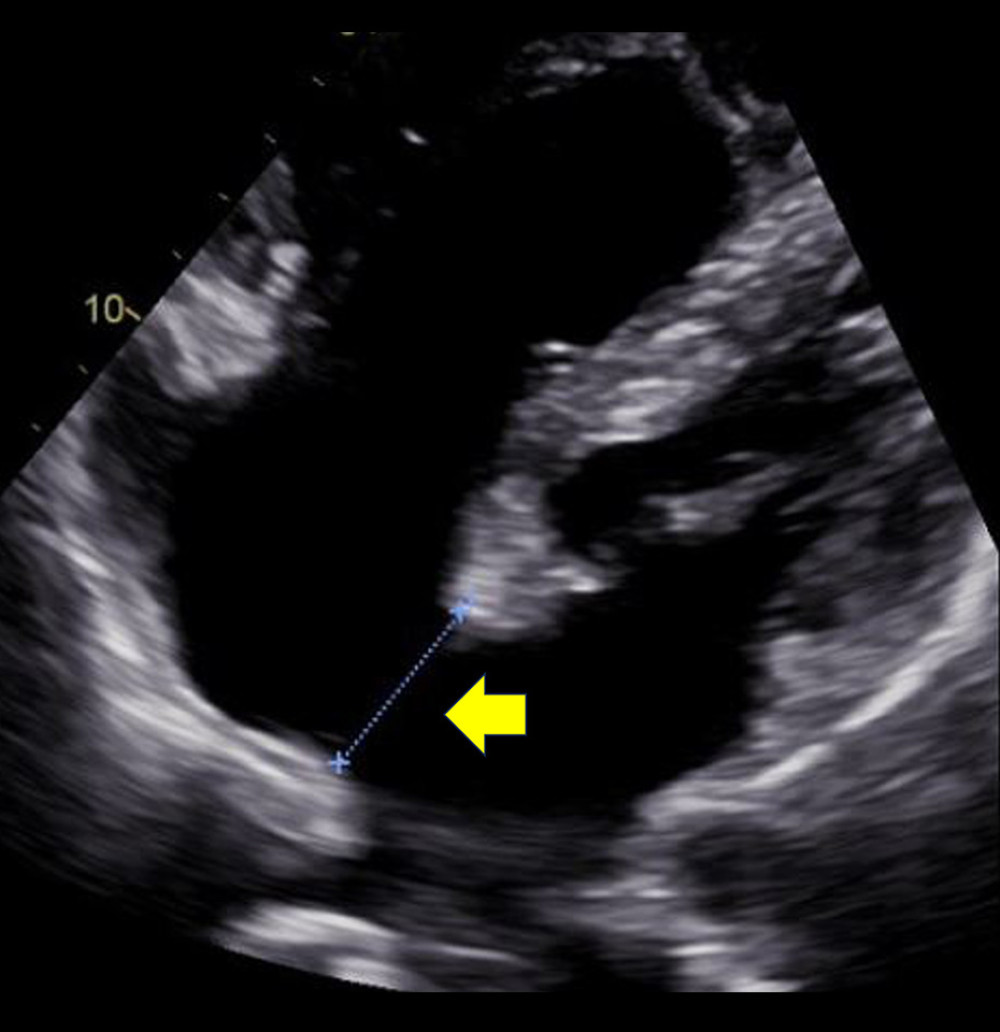 Preoperative transthoracic echocardiography shows an atrial septal defect (yellow arrow).