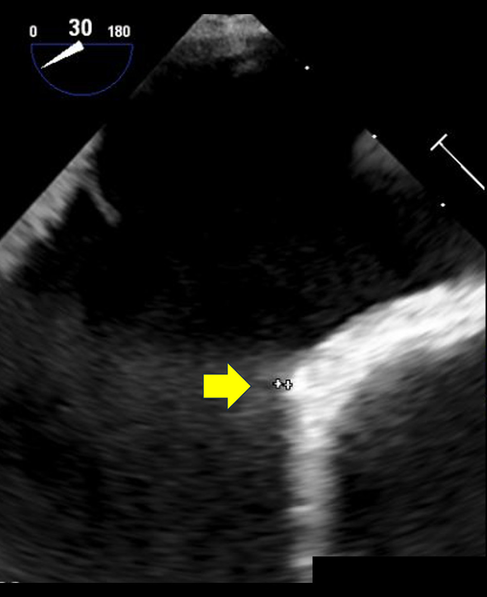 Preoperative transesophageal echocardiography shows a relatively small aortic rim of only 1 mm (yellow arrow).