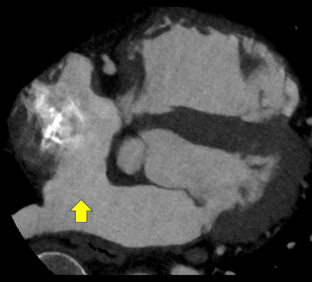Preoperative computed tomography scan shows an atrial septal defect (yellow arrow).