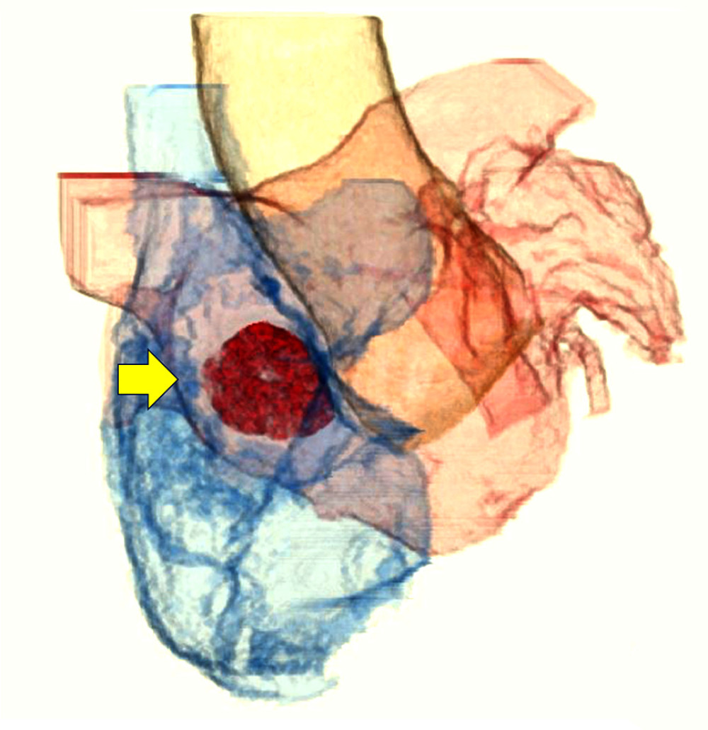 Preoperative computed tomography scan (volume rendering) shows an atrial septal defect (yellow arrow).