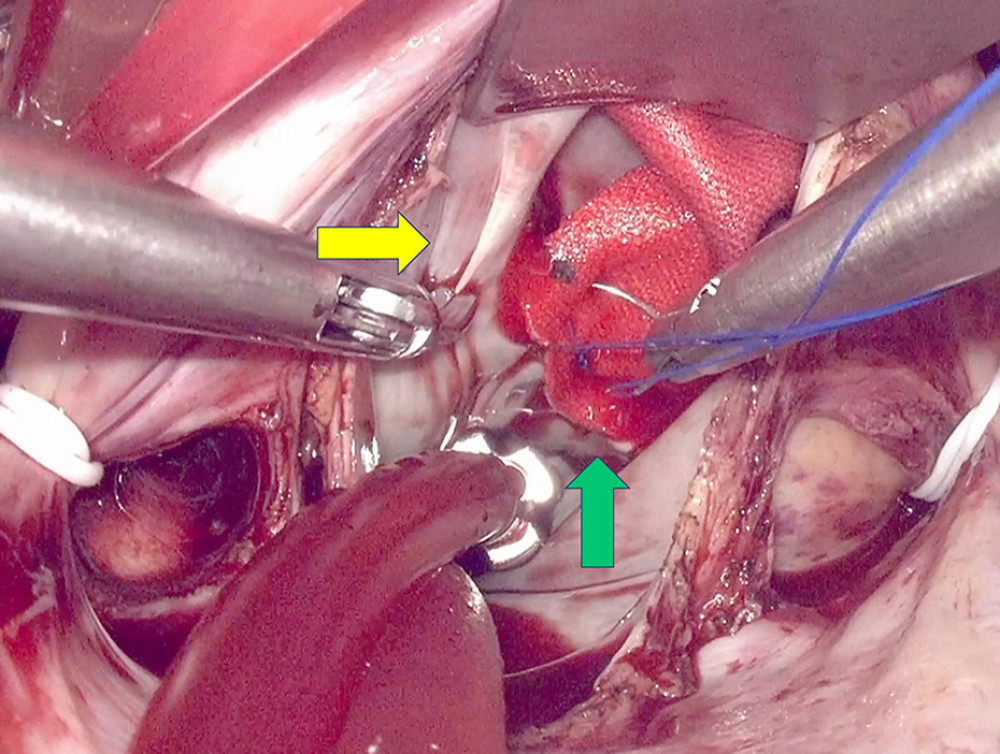Atrial septal defect patch closure was performed via the left atrial side approach using totally endoscopic minimally invasive cardiac surgery. The yellow arrow indicates the atrial septal defect margin; the green arrow represents the fabric sheet.