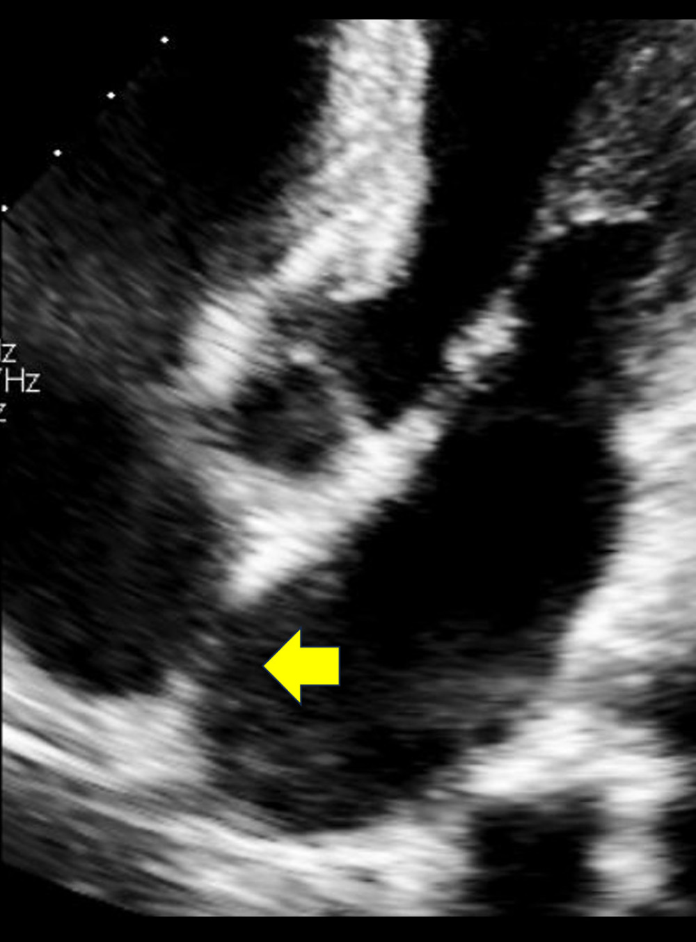 Postoperative transthoracic echocardiography shows no residual shunt.