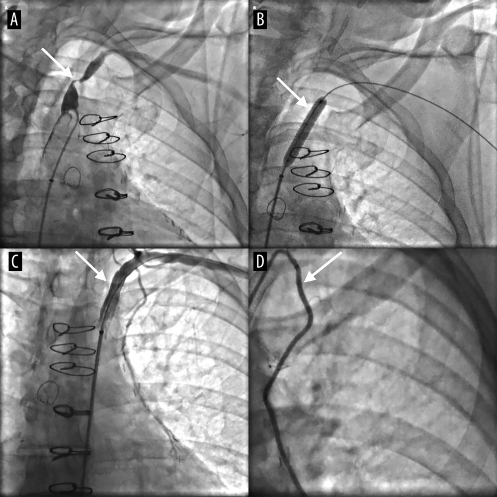 Sequential angiographic images demonstrating the interventional management of coronary-subclavian steal syndrome. (A) Severe proximal left subclavian artery stenosis prior to intervention. (B) Deployment of a balloon-expandable stent across the lesion. (C) Restoration of vessel lumen following stent placement. (D) Improved antegrade flow through the LIMA-to-LAD graft following revascularization.
