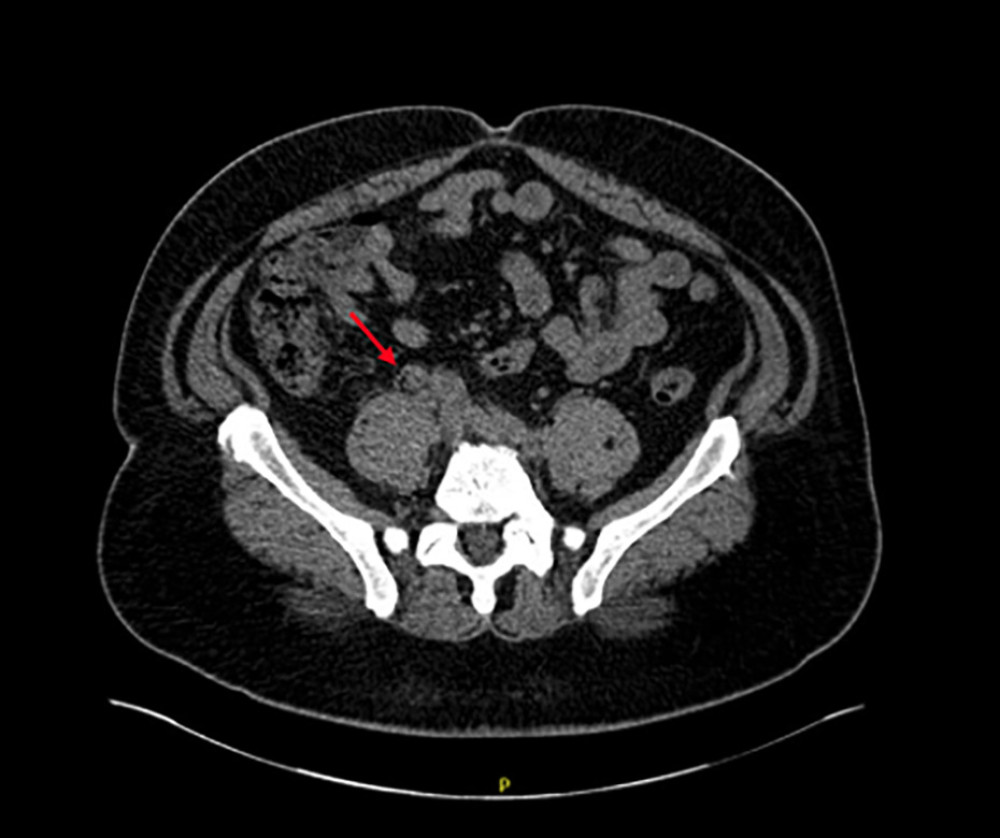 Computed tomography (CT) of the kidneys, ureters, and bladder with findings suggestive of primary upper tract urothelial carcinoma including distended proximal ureter. Severe right hydronephrosis was present but not fully visualized in this image.