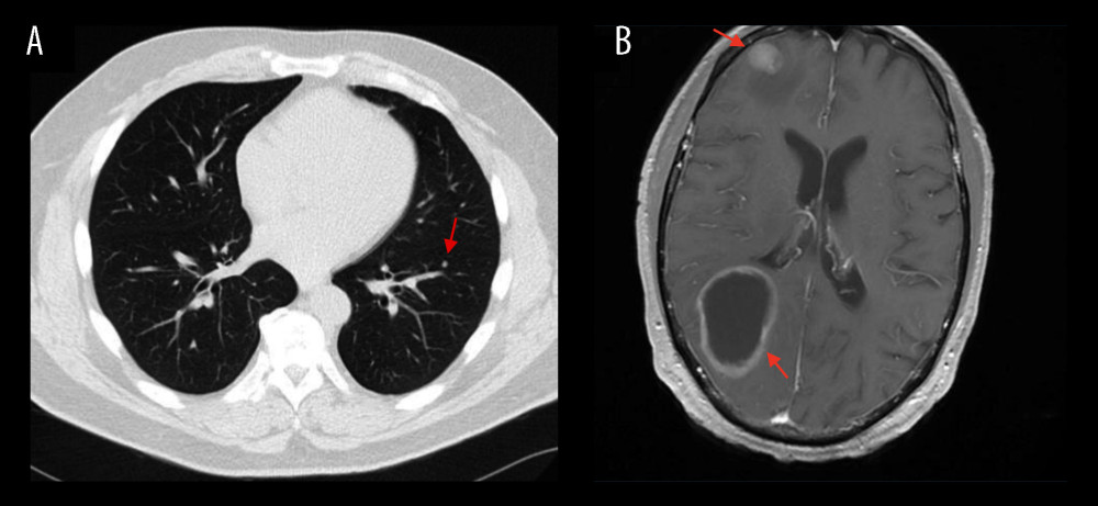 Radiologic progression of metastatic disease. (A) Computed tomography (CT) of the chest without contrast showing a newly enlarged 4-mm solid pulmonary nodule in the left lower lobe, suspicious for metastatic disease. (B) Contrast-enhanced magnetic resonance imaging (MRI) of the brain (axial T1-weighted post-contrast sequence) demonstrating a rim-enhancing cystic lesion in the right parietal lobe (posterior lesion), measuring 52×36 mm with no significant surrounding edema, with associated mass effect of the right ventricular trigone. In addition, a solid enhancing mass was visible in the right anterior frontal lobe measuring 13×15 mm, surrounded by vasogenic edema.