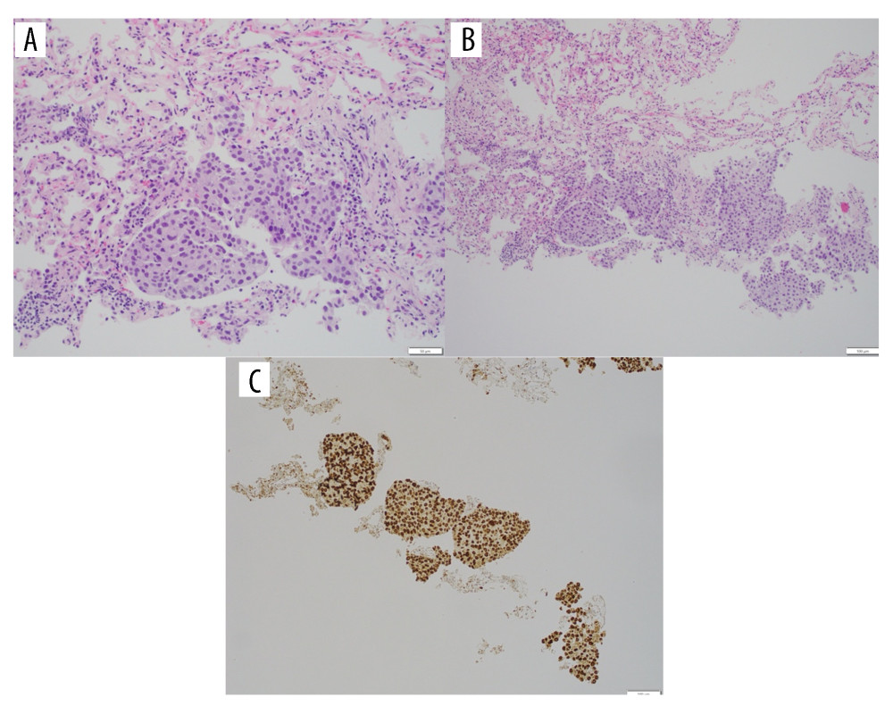 Histopathologic confirmation of pulmonary metastasis from urothelial carcinoma. (A) A high power (200×) hematoxylin and eosin (H&E)-stained section showing tumor cells with round-to-oval central nuclei and moderate amounts of eosinophilic cytoplasm, consistent with urothelial origin. (B) A low power (100×) H&E-stained section showing lung parenchyma with sheets of neoplastic cells within alveolar spaces. (C) GATA3 positive nuclear staining supportive of urothelial origin (GATA3 IPOX 100×).