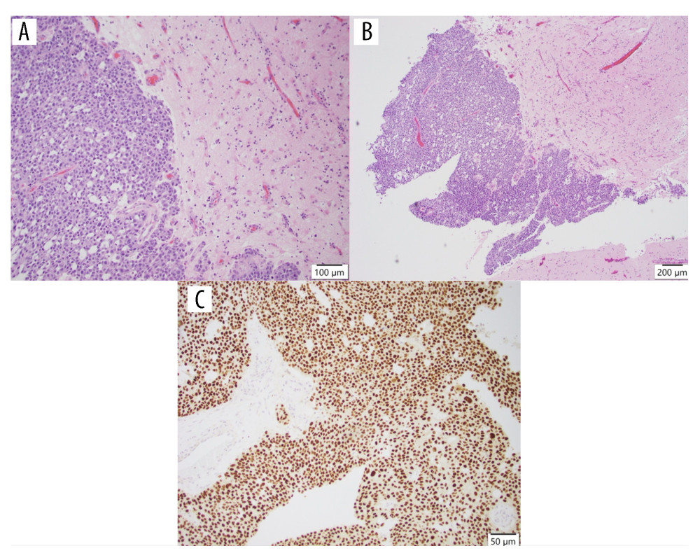 Histopathologic findings of brain metastasis. (A, B) Hematoxylin and eosin (H&E) histopathology at 100× and 200× power showing sheets of neoplastic epithelioid cells with moderately pleomorphic, enlarged nuclei and prominent nucleoli. Mitotic figures are present. Reactive gliosis is present in the surrounding brain tissue. (C) Nuclear immunoreactivity with antibody to GATA3 is consistent with the known urothelial origin.