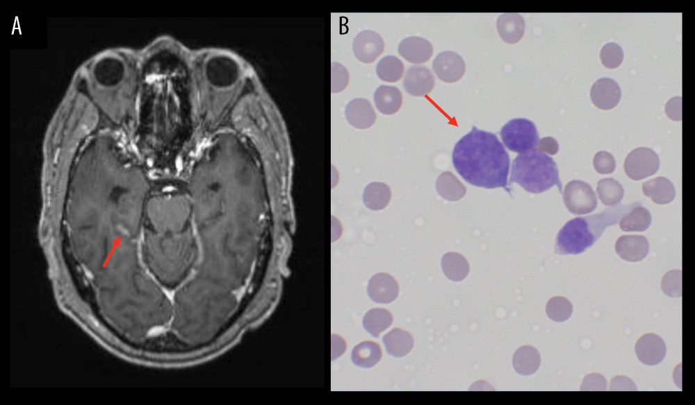 Radiologic and cytologic evidence of leptomeningeal spread. (A) T1-enhanced magnetic resonance imaging (MRI) showing more prominent sulcal enhancement in the right temporal lobe compared with prior images, suggestive of leptomeningeal disease. (B) May-Grünwald Giemsa (MGG) stain of the patient’s cerebrospinal fluid (CSF) shows scattered malignant cells with high nuclear to cytoplasmic ratios, dark chromatin, and irregular nuclear membranes (60× objective).