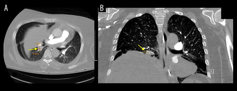 CT pulmonary angiography showing segmental and subsegmental pulmonary emboli (yellow arrows) and a giant right hepatic cyst measuring 29 × 18 cm, exerting right-hemithoracic mass effect with leftward mediastinal displacement. (A) Axial image. (B) Coronal image