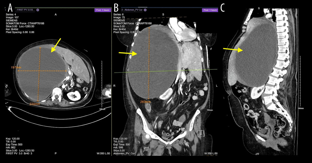 CT abdomen, showing a hydatid cyst with mass effect with IVC thrombosis in A: axial, B: coronal, and C: sagittal planes. The arrows point to the hydatid cyst in the liver.