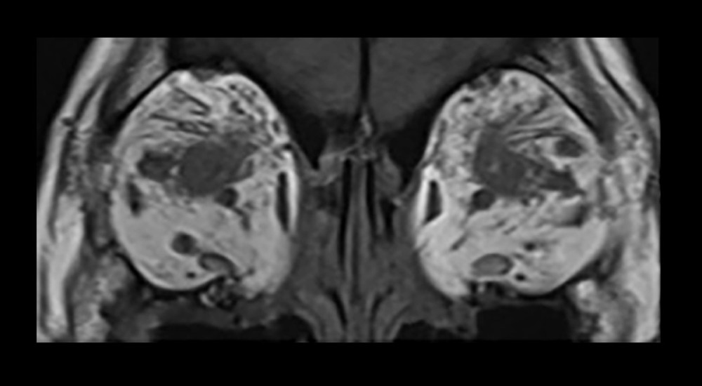Coronal orbital magnetic resonance imaging findings (T1-weighted and fat-suppressed images using short-tau inversion recovery sequences); bilateral extraocular muscle enlargement with tendon sparing (TED) and diffuse orbital soft tissue /lacrimal gland infiltration with high STIR signal (IgG4-RD).