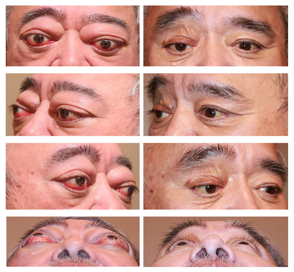 Clinical photographs of the patient. Left: Pre-surgery view. Right: Six months after surgery, showing a reduction in proptosis, orbital pain, and overall improvement in appearance.