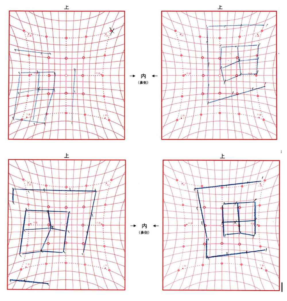 Hess chart analysis of ocular motility: At first visit (above) the left panel represents the right eye (RE), and the right panel represents the left eye (LE). There are marked right inferior rectus restriction with significant field contraction in the RE and expansion in the left superior field. At 2-week follow-up (below), there is partial improvement in ocular motility with a less contracted right eye field and reduced overaction of the left superior rectus, indicating recovery of restrictive strabismus.