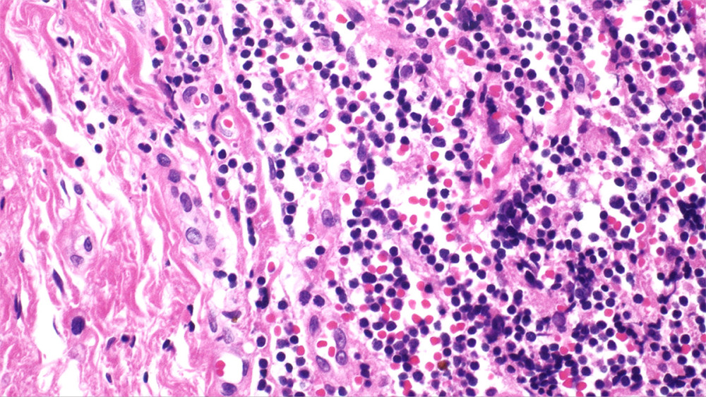 Low-power view of orbital tissue showing diffuse lymphoplasmacytic infiltration with associated fibrosis (H&E stain, original magnification ×40). The inflammatory infiltrate is distributed in a patchy to diffuse pattern within the stromal background.