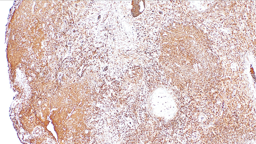 Immunohistochemical staining for IgG demonstrating numerous IgG-positive plasma cells diffusely distributed throughout the lesion (original magnification ×100), consistent with a plasma cell-rich inflammatory process.