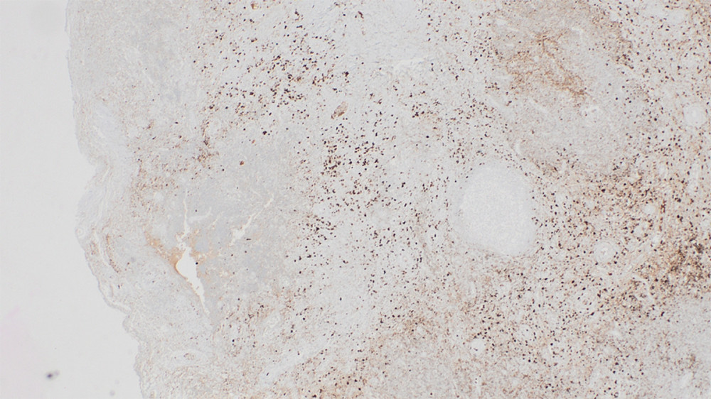 Immunohistochemical staining for IgG4 revealing a markedly increased number of IgG4-positive plasma cells (original magnification ×100). Quantitative assessment showed > 50 IgG4-positive plasma cells per high-power field with an IgG4/IgG ratio > 40%, supporting the diagnosis of IgG4-related disease.