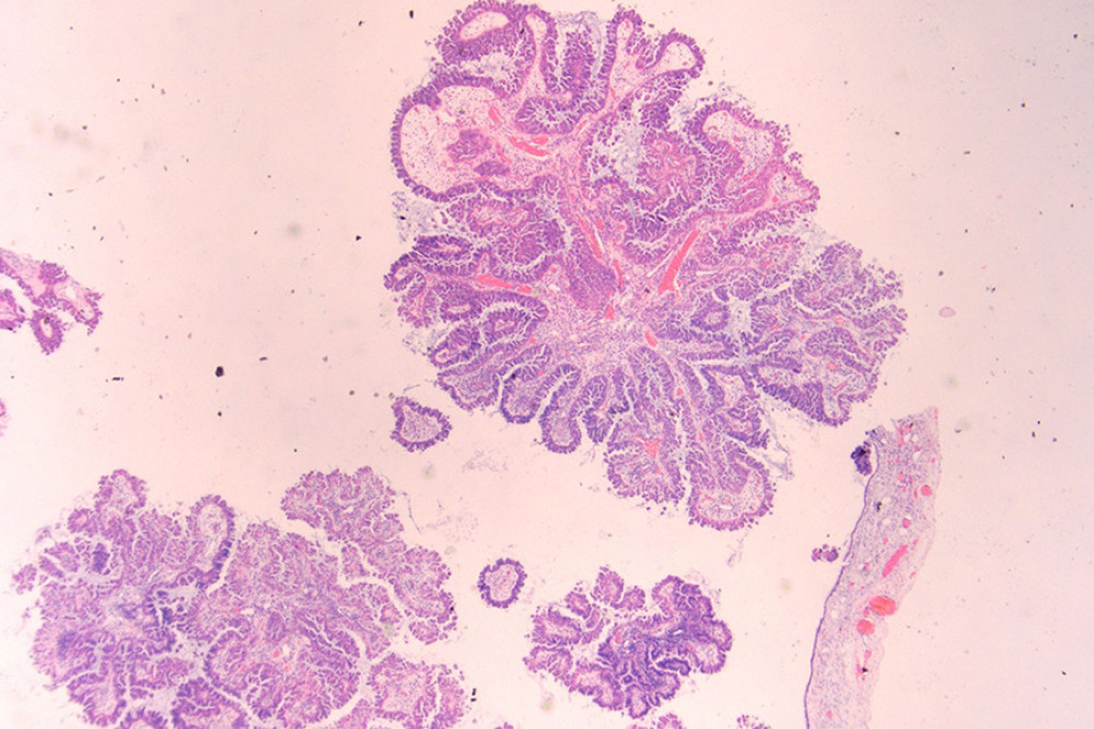 A complex branched papillary tumor is observed within the cyst. The papillary stroma contains fibrovascular cores, with no definite invasive foci identified. The epithelial cells lining the papillae show micropapillary changes in some areas. (HE staining, low magnification).