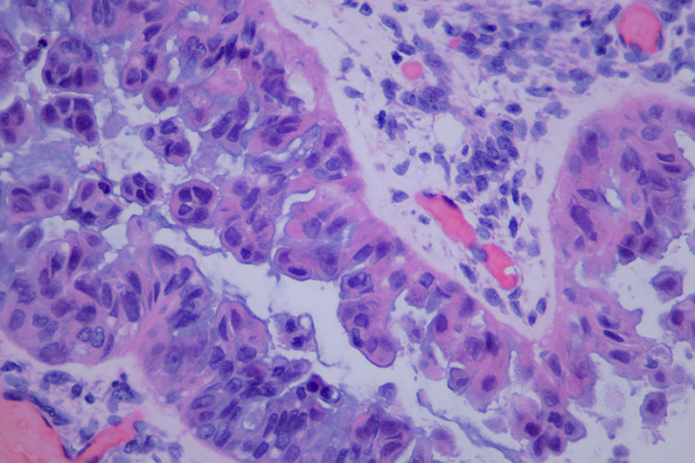 The tumor cells lining the papillae are arranged in multiple layers, with eosinophilic cytoplasm showing serous features, mild to moderate nuclear atypia, no definite nucleoli identified, and rare mitotic figures. (HE staining, high magnification).