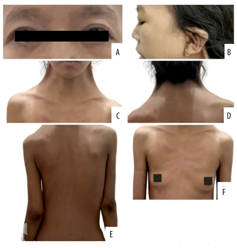Patient’s clinical manifestation showing the characteristic features of Noonan syndrome. The images depict characteristic features including hypertelorism, down-slanting palpebral fissures (A), low-set ears (B), webbed neck (C), low posterior hairline (D), scoliosis (E), and a shield-shaped chest with widely spaced nipples (F).