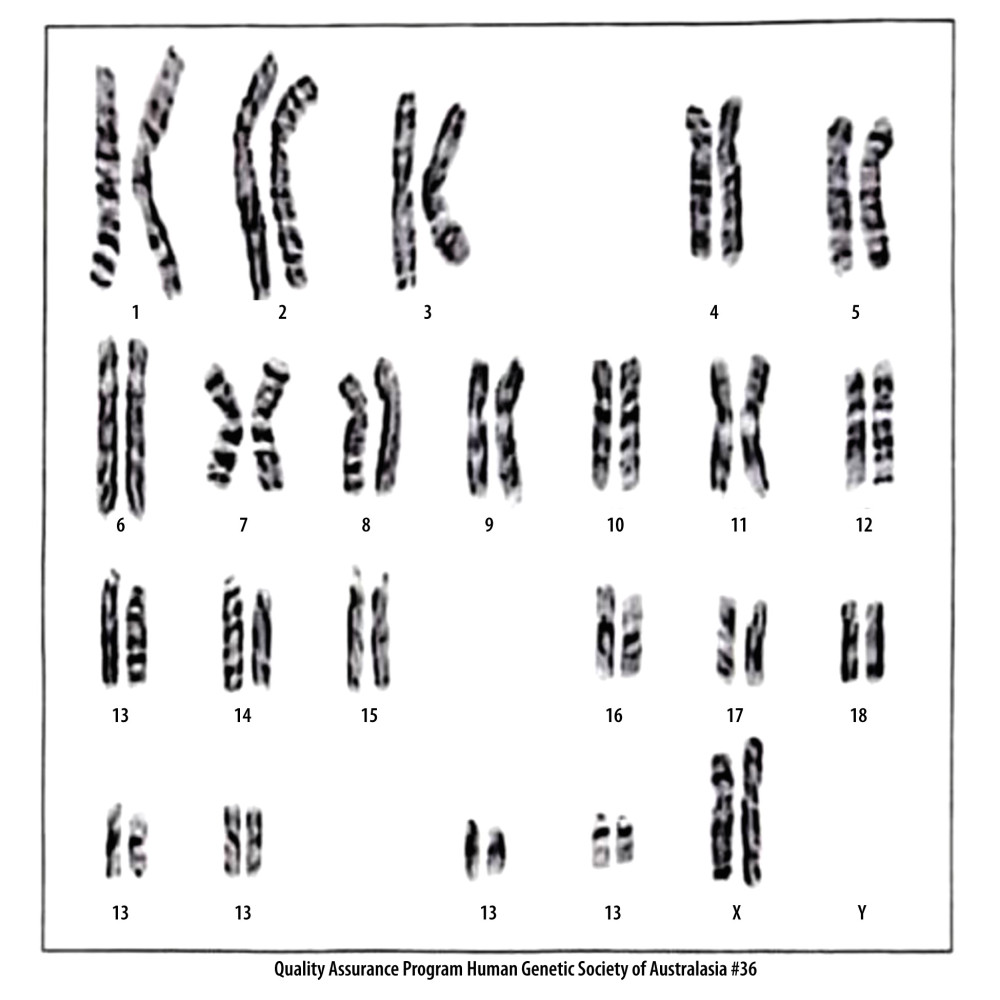 Karyotype analysis of the current patient showing a normal female karyotype (46, XX). Karyotyping was performed to exclude Turner syndrome, an important differential diagnosis in female patients with suspected Noonan syndrome. As expected for Noonan syndrome, no chromosomal abnormalities were identified. Molecular confirmation using a RASopathy gene panel (eg, PTPN11 and related genes) was not available.