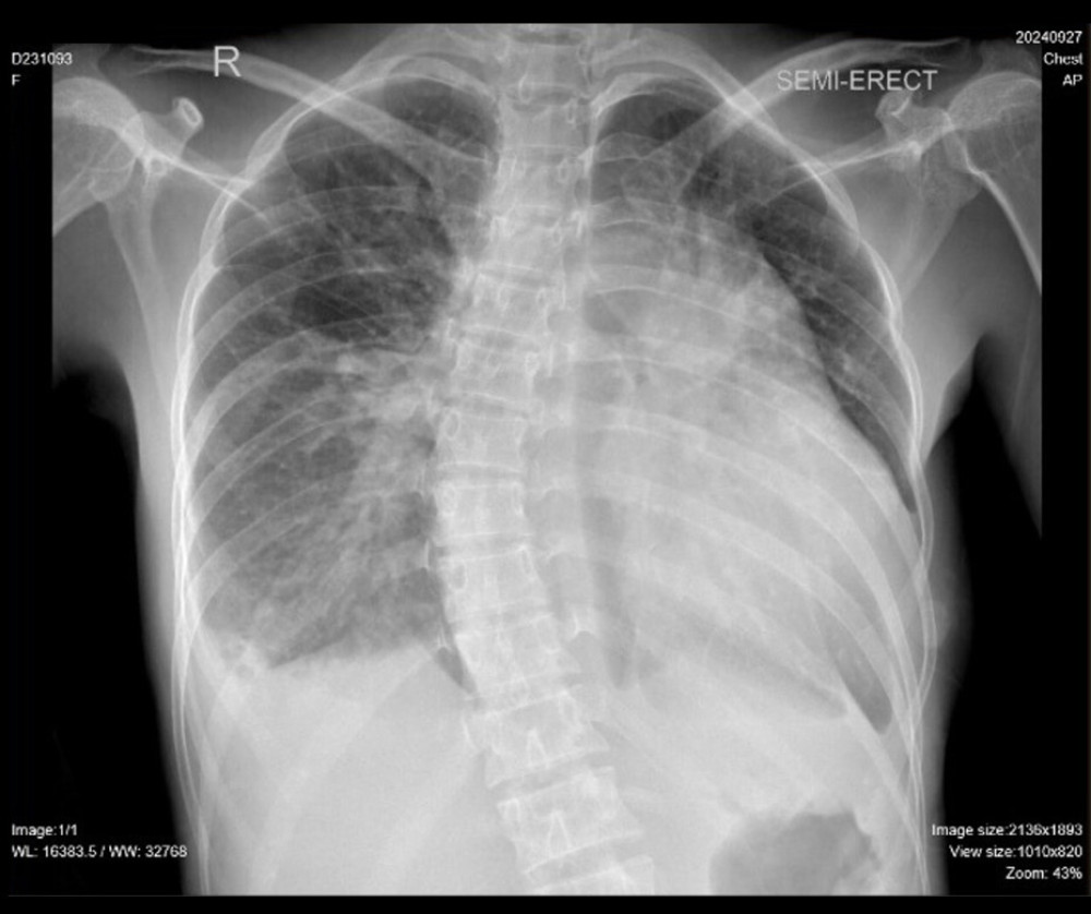 Chest Radiograph. Chest X-ray demonstrating cardiomegaly, pleural effusion, pulmonary edema, and vascular congestion.