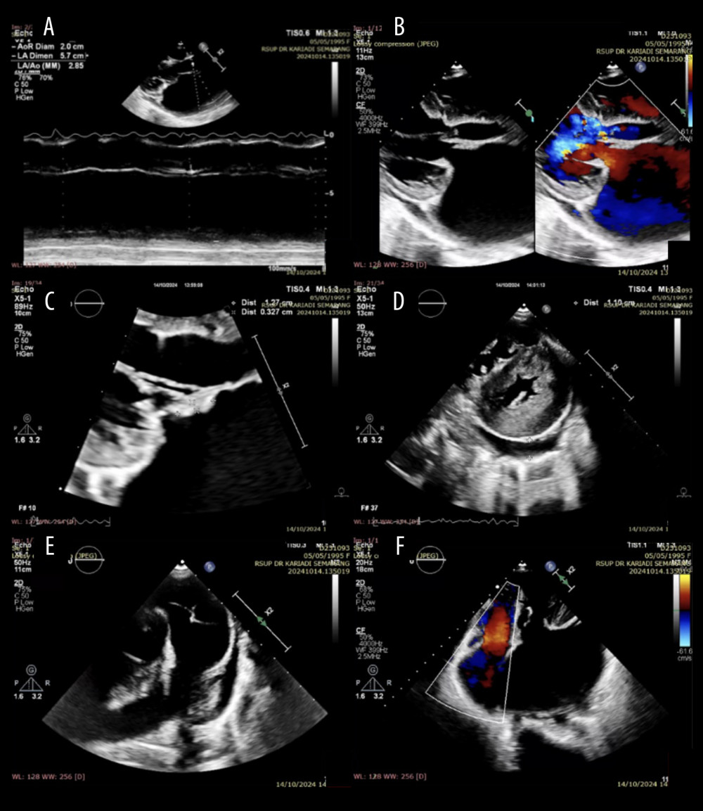 Echocardiogram showing mitral regurgitation with vegetations and pericardial effusion. (A) Dilated left atrium and eccentric left ventricular hypertrophy with a left ventricular ejection fraction (LVEF) of 69.9%. (B) Severe mitral regurgitation due to a flail anterior mitral leaflet (AML) with an oscillating mass on the AML. (C) Oscillating mass (+) on the AML measuring 1.2 × 0.3 cm. (D) Left ventricle (LV) showing a D-shape during systole and diastole. The LV was globally normokinetic. Loculated pericardial effusion was visible posterior to the LV. (E) A mass was present in the right ventricular outflow tract, suspected to be vegetation, pedunculated, measuring 1.3 × 0.6 cm. The main pulmonary artery was dilated. (F) Moderate tricuspid regurgitation (TR), TR vena contracta 0.3 cm, TR Vmax 2.4 m/s, MaxPG 23 mm Hg.