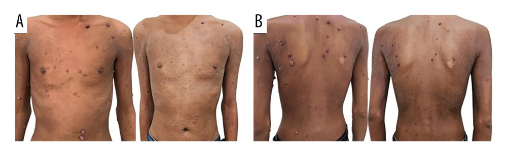 The lesions are observed on the thorax (A) and back (B). Nodular and crateriform lesions characterized by central keratosis, crust, and erythematous-violaceous infiltrated edges. Clinical presentation of the lesions before and after 6 months of observation under a watch-and-wait approach. There is a significant reduction in lesion size and improvement in the skin’s overall condition.