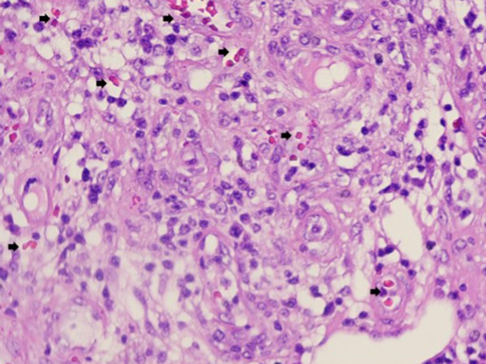 The morphological features of the nasal cavity biopsy highlighting the pleomorphic cells (black arrow) and lack of necrosis, consistent with a diagnosis of histiocytic sarcoma.