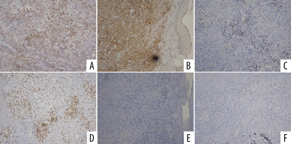 The immunohistochemical findings support the diagnosis of histiocytic sarcoma, with positive staining for (A) CD68 (histiocytic marker), (B) CD45 (hematopoietic origin), and a high proliferation index with (C) Ki67 (60–70%). Negative results for (D) CD3, (E) CD20, (F) CD30, CD34, and S100 exclude lymphoma, dendritic neoplasms, and Langerhans cell tumors.