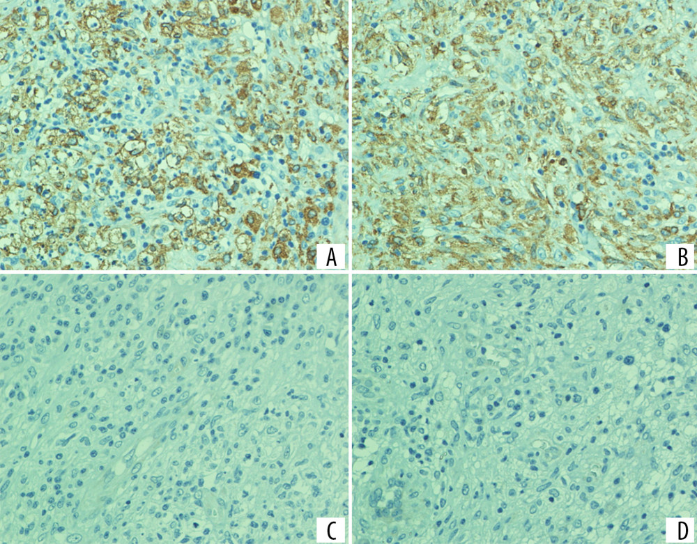 Immunohistochemical profile of the lesion; (A) CD163 showing positive cytoplasmic staining in tumor cells; (B) lysozyme showing positive staining, supporting histiocytic differentiation; (C) CD1a showing negative staining; (D) langerin (CD207) showing negative staining. The positivity of CD163 and lysozyme, together with the absence of CD1a and langerin expression, supports the diagnosis of histiocytic sarcoma and excludes Langerhans cell histiocytosis.