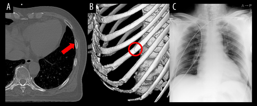 Chest X-ray and computed tomography findings in the emergency department.Computed tomography revealed the fracture of the left seventh rib (A, B), and chest X-ray revealed mild cardiomegaly without pleural effusion or pulmonary congestion (C). A red arrow and a circle indicate the fracture site.
