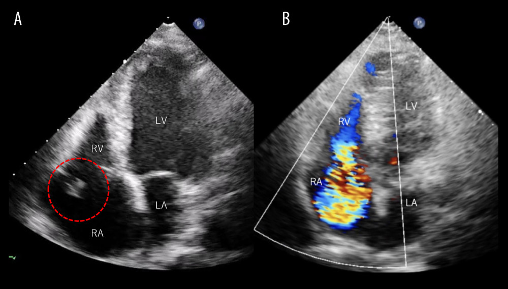 Transthoracic echocardiography findings on hospital day 2.Transthoracic echocardiography demonstrated a 7-mm mobile, mass-like structure attached to the flail anterior tricuspid leaflet (A, red dotted circle) with a severe eccentric regurgitant jet (B). Abbreviations: LA, left atrium; LV, left ventricle; RA, right atrium; RV, right ventricle.