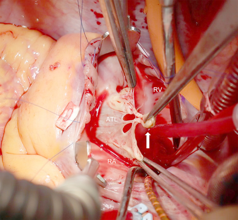 Intraoperative Image.The white arrow indicates the ruptured tip of the papillary muscle connected to the chordae tendineae of the anterior tricuspid leaflet, resulting in prolapse of the leaflet. Abbreviations: ATL, anterior tricuspid leaflet; RA, right atrium; RV, right ventricle.