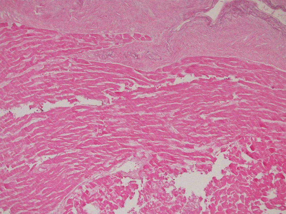 Microscopic image of the ruptures papillary muscle.Pathological examination showed coagulative necrosis.