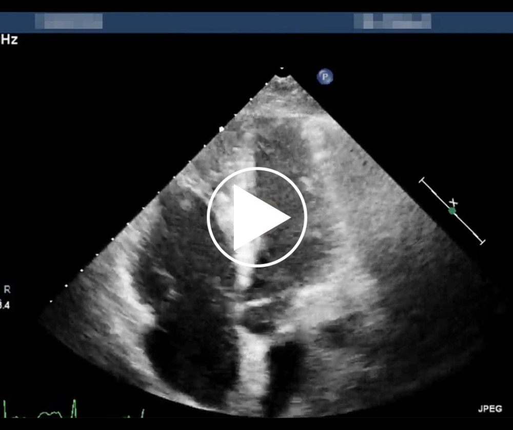 The apical 4-chamber view on transthoracic echocardiography shows a 7-mm mobile mass-like structure attached to the anterior tricuspid leaflet, demonstrating pronounced flail motion.