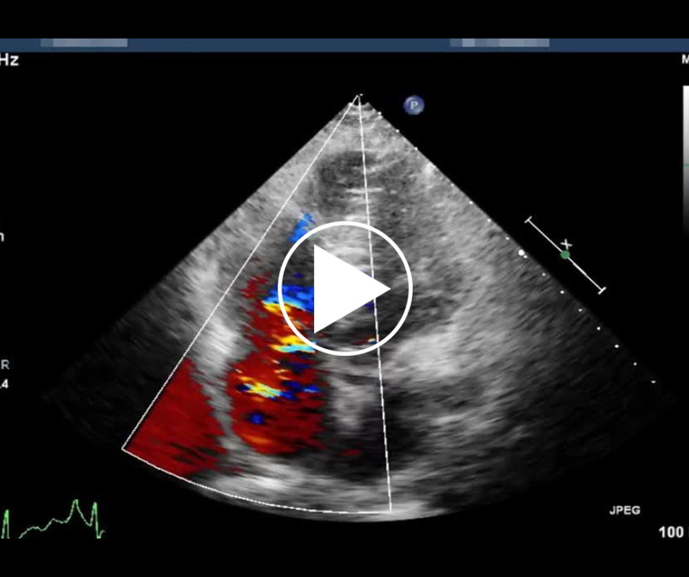A color Doppler image demonstrating pronounced tricuspid regurgitant.