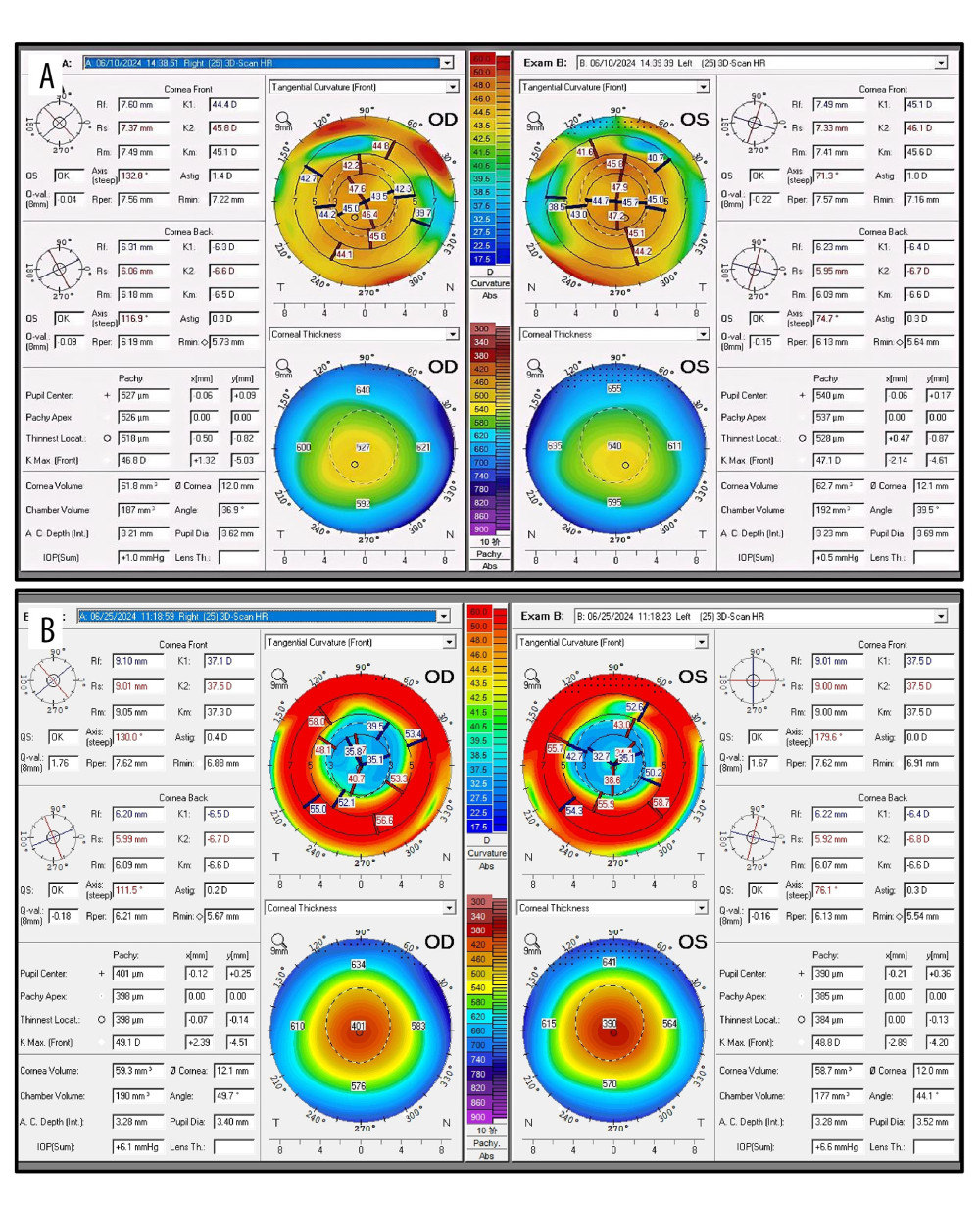 Images showing corneal topography. (A) Preoperative; (B) 2 days after surgery. Abbreviations: OD, right eye; OS, left eye.