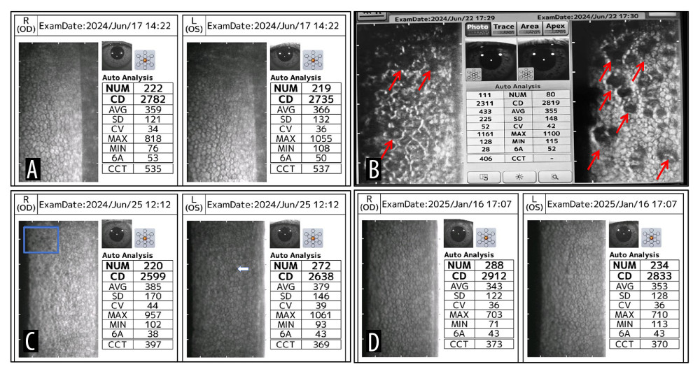 Images showing corneal endothelial microscopy. (A) Preoperative endothelial microscopy. (B) Corneal endothelial microscopy on postoperative day 3 showing hyporeflective zones on the endothelial surface in both eyes; the right eye (OD), affected by corneal edema, is not clearly visualized. Red arrows indicate the hyporeflective zones. (C) At 1 week postoperatively, the number and area of hyporeflective zones are significantly reduced; however, a few small hyporeflective zones remain visible (blue box in the right eye and white arrow in the left eye [OS]). (D) At 6 months postoperatively, endothelial cell density and percentage of hexagonal cells show further recovery, with no significant hyporeflective zones observed.